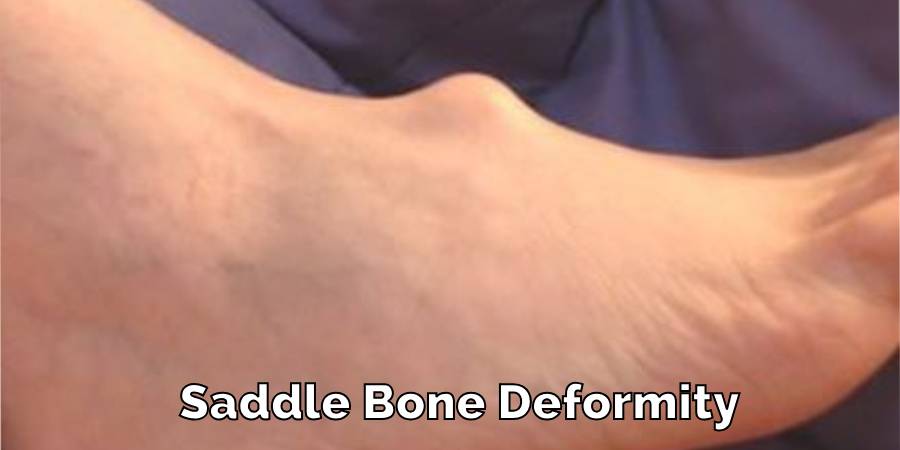 Saddle Bone Deformity