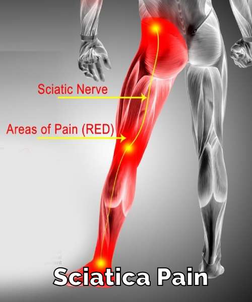 Sciatica Pain