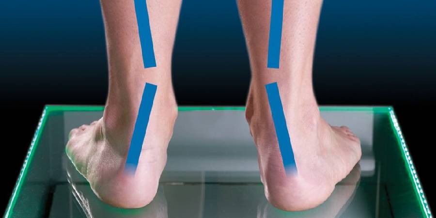 What is Overpronation